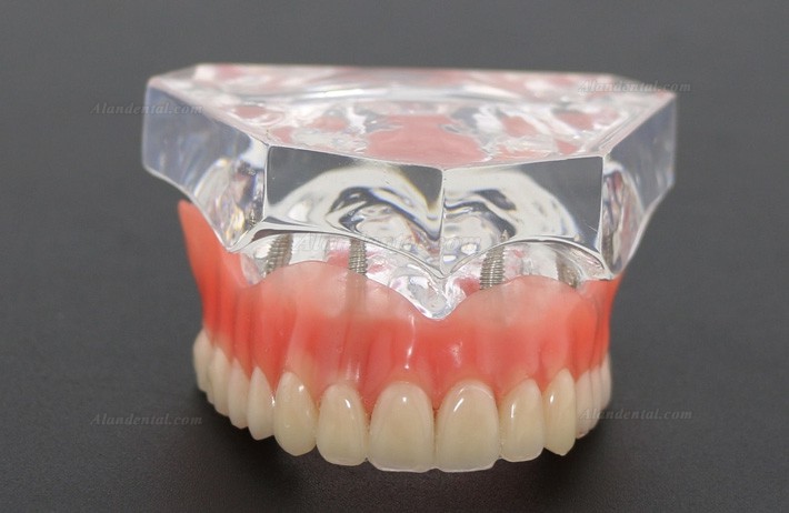 Dental Study Teeth Model Overdenture Superior With 4 Implants Demo Model 6001